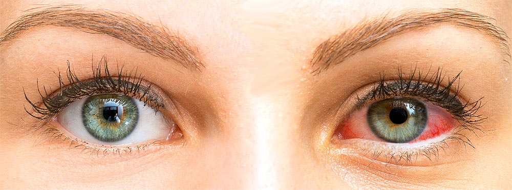 dry eye